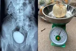 سنگ مثانه عجیب در بدن یک انسان کشف شد + عکس