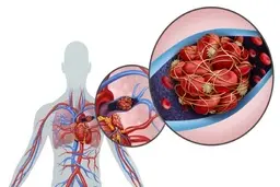 تا حالا اسم بیماری آمبولی به گوشت خورده؟! | علت اختلال آمبولی چیست؟