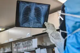 بعد از بهبودی اثری از کرونا روی ریه مبتلایان باقی می‌ماند؟