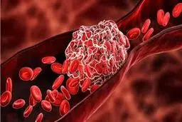 این دردها نشانگر لخته شدن خون در بدن است |  جدی بگیرید