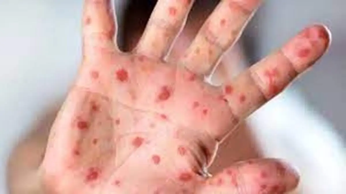واکسیناسیون تمام کودکان زیر ۵ سال برای مقابله با سرخک ضرورت ندارد 