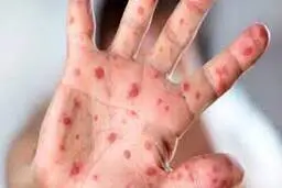 واکسیناسیون تمام کودکان زیر ۵ سال برای مقابله با سرخک ضرورت ندارد 