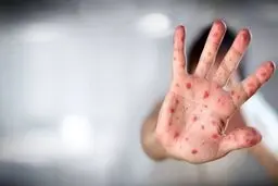 آبله میمونی قوت گرفت | هوا هم عامل انتقال شد | هشدار انتقال سریع آبله میونی