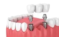 ایمپلنت هوشمند برای بیماران دیابتی | به‌طور خودکار در بدن بیماران دیابتی دارو آزاد می‌کند