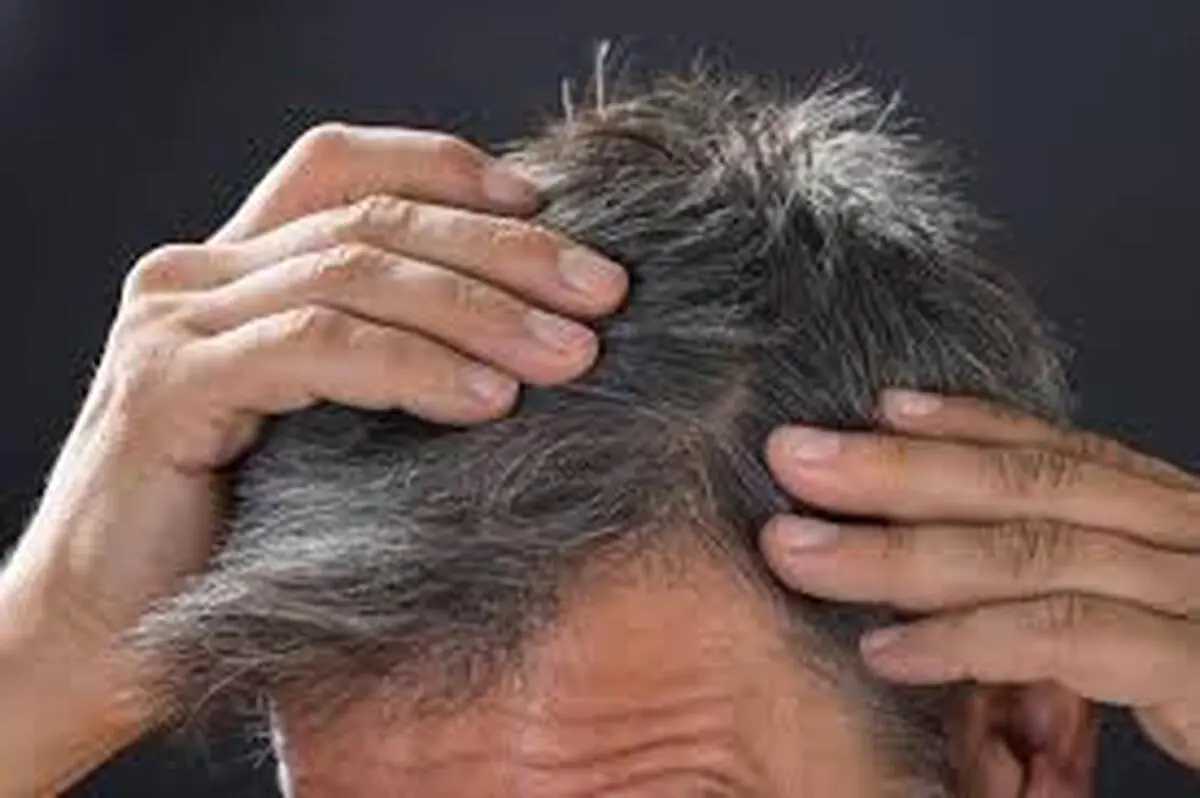 استرس یکی از عوامل سفیدی موی انسان است 
