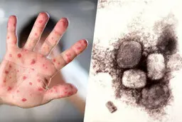 بهبود خود به خودی آبله میمون در افراد عادی بین ۲ تا ۴ هفته