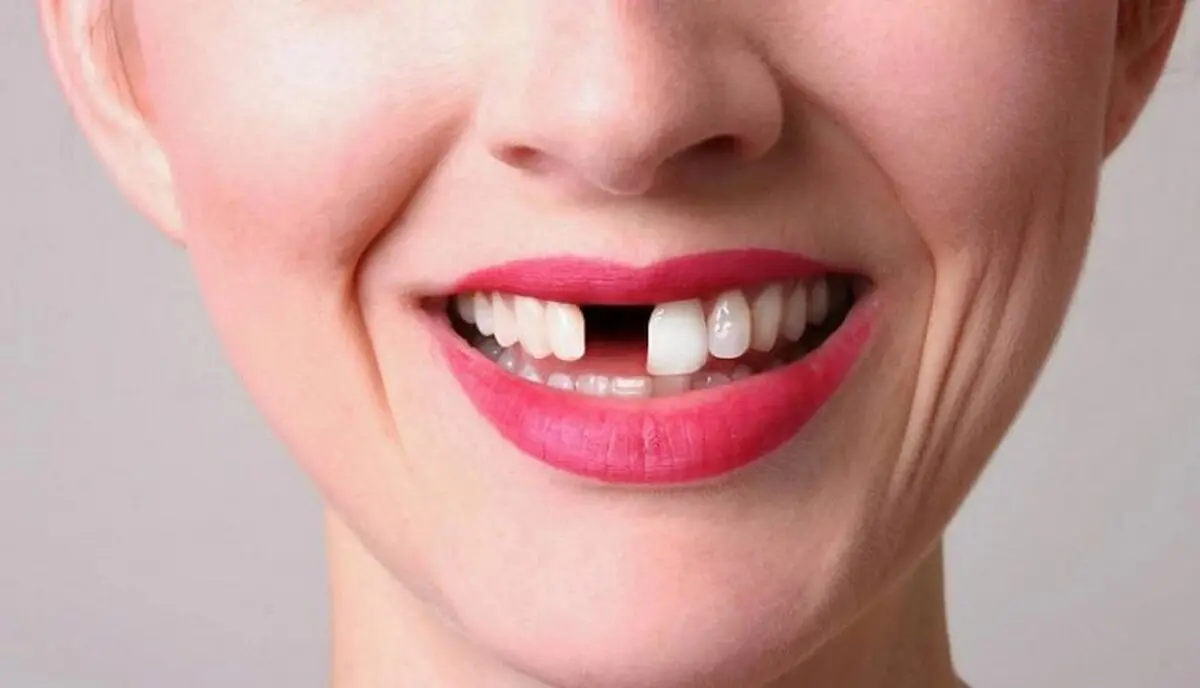 تعبیر دیدن افتادن دندان در خواب چیست؟ | تعبیر خواب افتادن دندان 