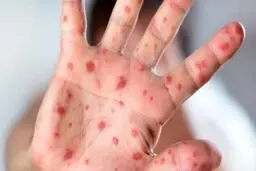 وزارت بهداشت: "عفونت مغزی" و "کوری" از عوارض بیماری سرخک است | بزرگسالانِ واکسن نزده هم در معرض ابتلا قرار دارند