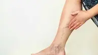 حرکات ورزشی برای بهبود بیماری واریس | با این چند تا حرکت ساده به جنگ با واریس برو +ویدئو