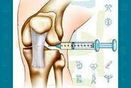 تزریق مفصلی بوتاکس در درمان مفاصل چه نقشی دارد؟ 