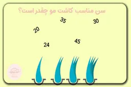 قبل از اینکه برای کاشت مو تصمیم بگیرید این نکات را بخوانید