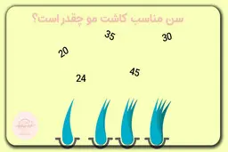 قبل از اینکه برای کاشت مو تصمیم بگیرید این نکات را بخوانید