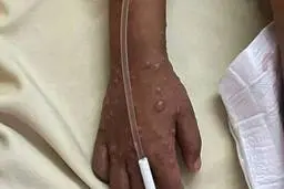 تست کودک قمی مشکوک به آبله میمون منفی اعلام شد