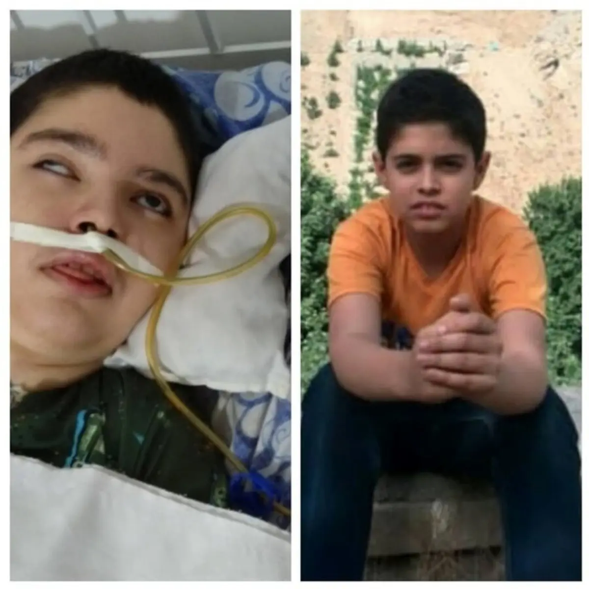 
 بیماری‌ | پسربچه ۱۳ ساله حدودا  بعد۶ سال ازکمادرآمد
