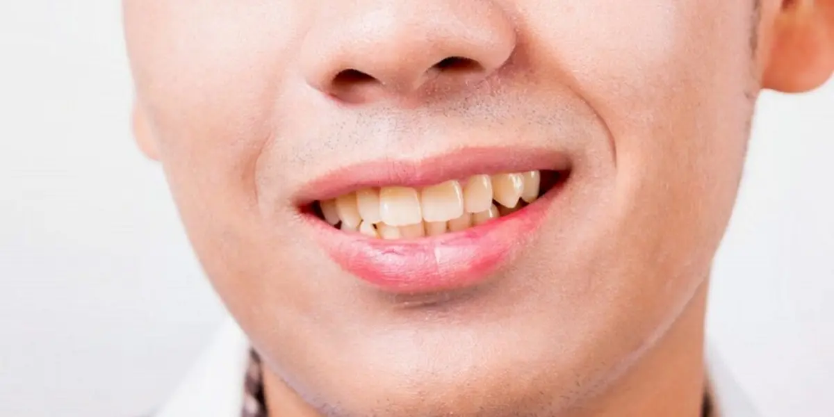  ترومای دندان چیست؟| تاثیر تروما در گفتار و بیان کودکان