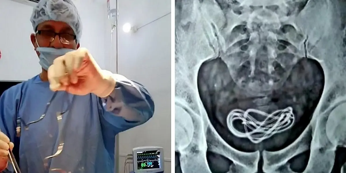  شارژر موبایل چطور از مثانه ی این مرد سردرآورده؟