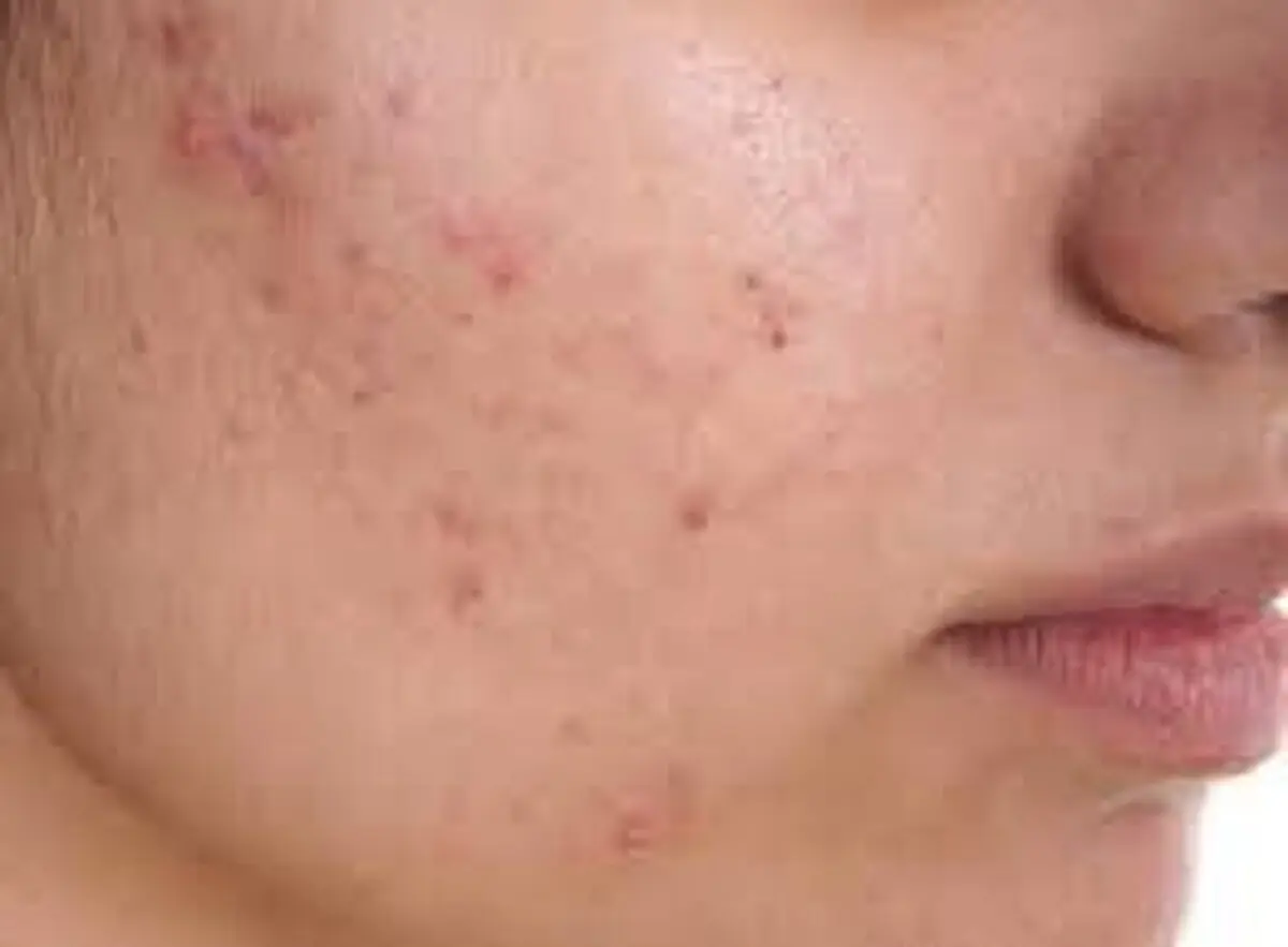 از موبایل تا لمس صورت؛ چهار عادتی که روی پوست آکنه ایجاد می‌کند