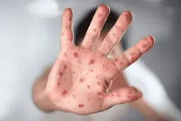 شیوع پنهانی آبله میمونی تایید شد | این بیماری موزی در حال شیوع است!