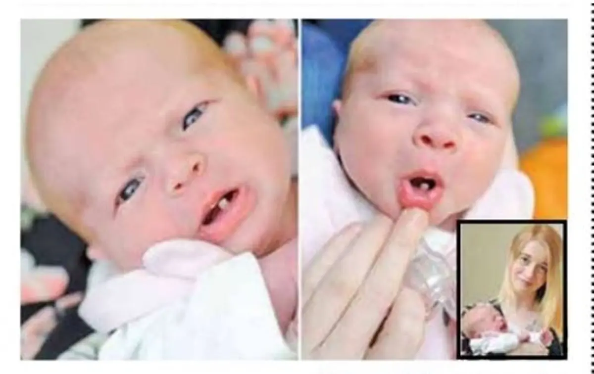 نوزادی که با یک دندان متولد شد!