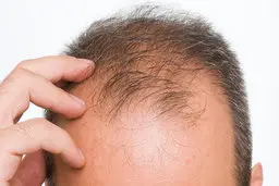 اشاره به ریزش موی مردان نوعی آزار جنسی است