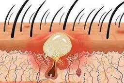 8درمان خانگی و سریع جوش پوست سر