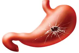نوشیدن این چهار دمنوش به درمان زخم معده کمک‌میکند