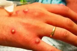 خبر خوب درباره آبله میمونی | نحوه انتقال آبله مشخص شد | از راه هوا انتقال نمی یابد | انتقال فقط از طریق 2 عامل