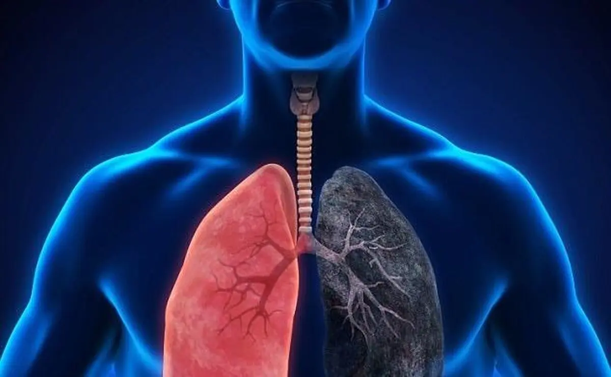 یک عامل مهم ابتلا به بیماری انسداد مزمن ریوی