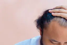 استرس مزمن باعث ریزش مو می‌شود
