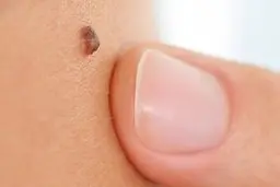 این مدل خال بر روی بدن نشان از خطرناک ترین بیماری است!