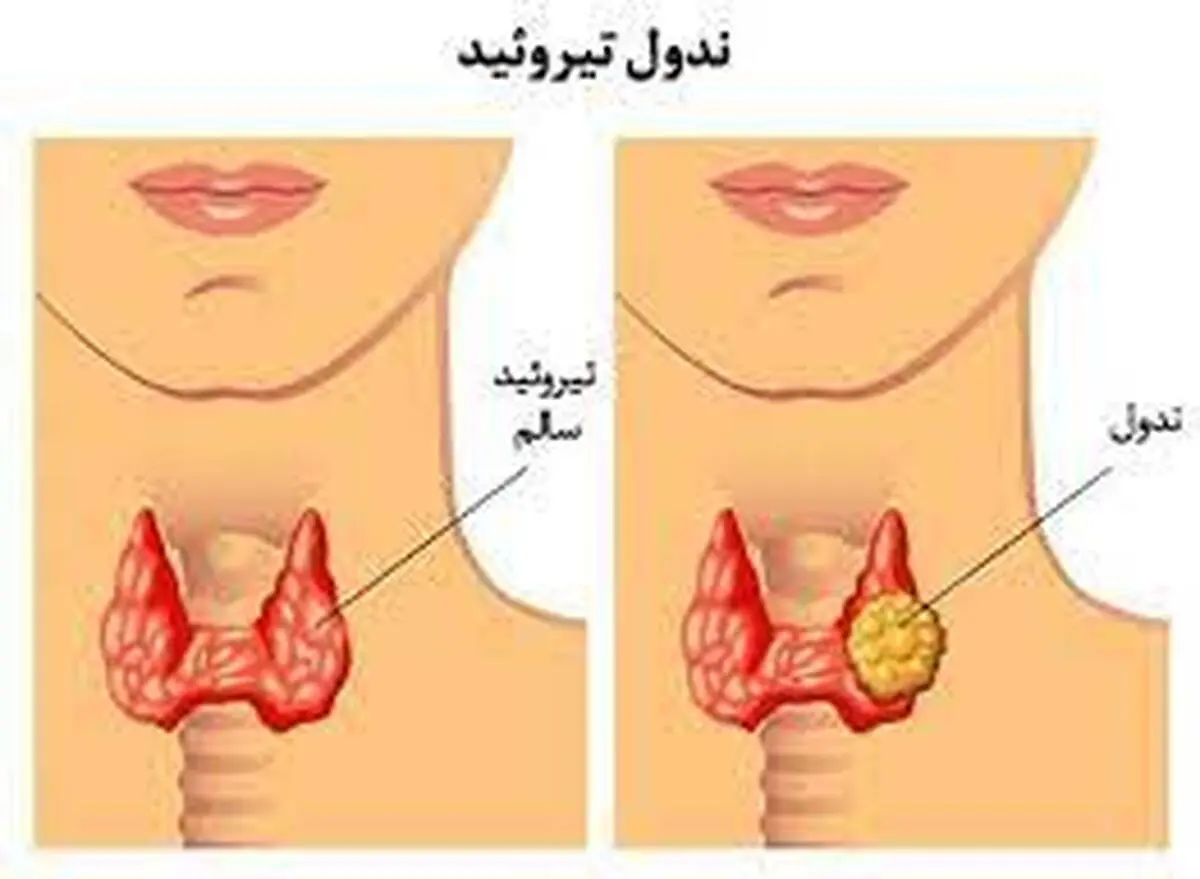 علائم پرکاری تیروئید | درمان پرکاری تیروئید از سه طریق امکان‌پذیر است