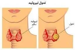 علائم پرکاری تیروئید | درمان پرکاری تیروئید از سه طریق امکان‌پذیر است
