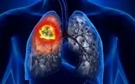سلامت عمومی جامعه : ارتباط آلودگی هوا با افزایش ابتلا به سرطان ریه 