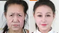 جراحی زیبایی خارق العاده دختر ۱۵ ساله چینی که به بیماری «پیری زودرس» مبتلا بود