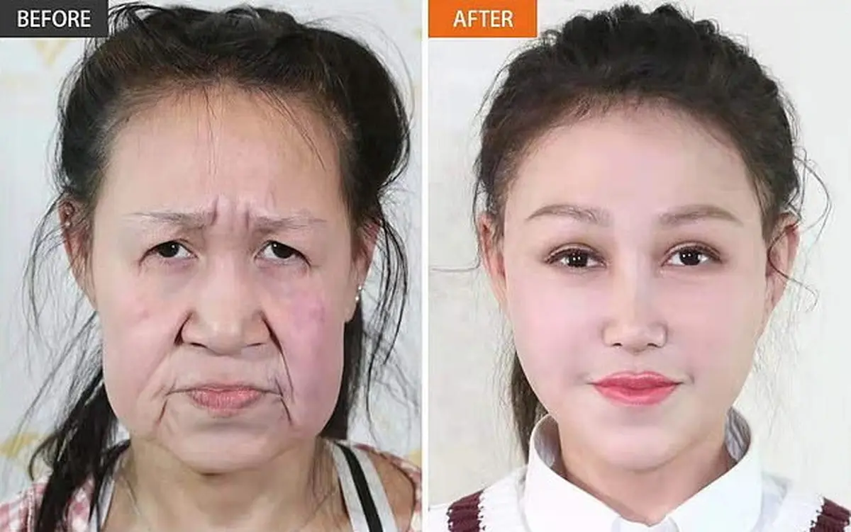 جراحی زیبایی خارق العاده دختر ۱۵ ساله چینی که به بیماری «پیری زودرس» مبتلا بود