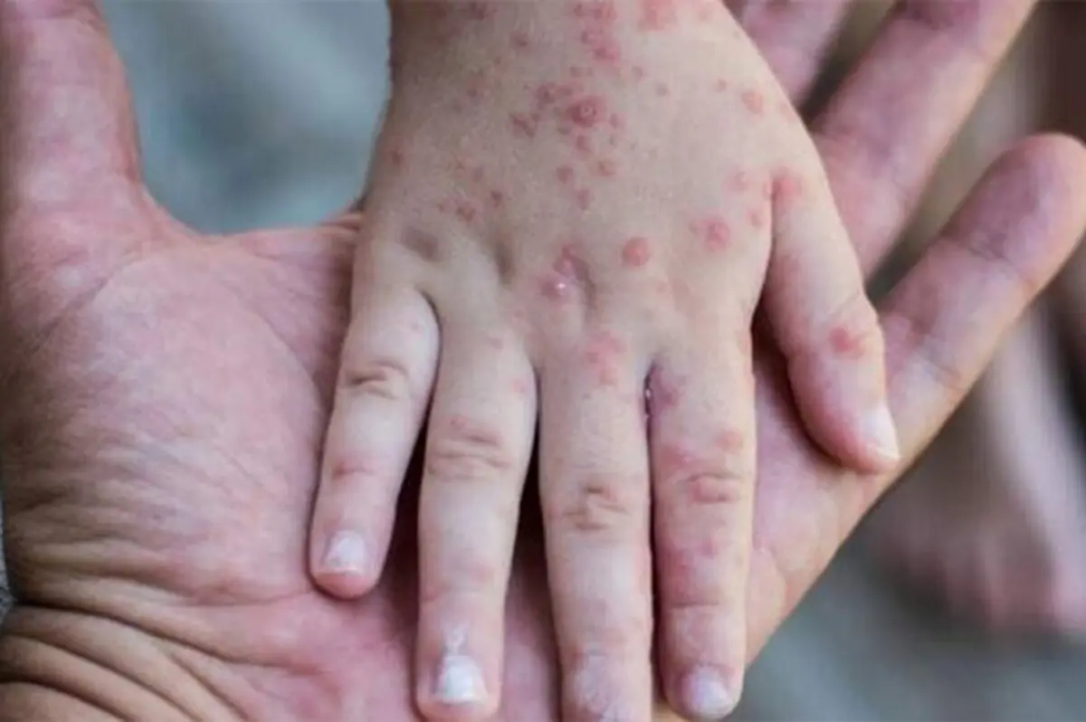 علائم سرخک چیست؛ آن‌ها را جدی بگیرید