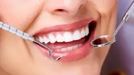 مزایا و معایب بلیچینگ دندان 