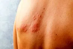 این بیماری پوستی را جدی بگیرید باعث سکته مغزی می شود!