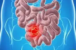 آندوسکوپی و کولونوسکوپی را در اپیدمی کرونا به تعویق نیندازید 