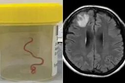 نجات بیمار چینی با خارج کردن کرم ۱۸ سانتی‌متری از مغز
