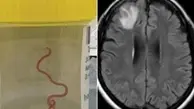 نجات بیمار چینی با خارج کردن کرم ۱۸ سانتی‌متری از مغز