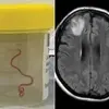 نجات بیمار چینی با خارج کردن کرم ۱۸ سانتی‌متری از مغز