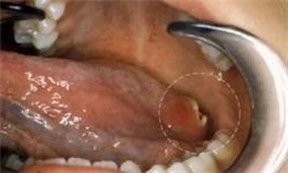 دندان دردی که نشانه سرطان است! | سرطان دهان کمتر شنیده شده٬ آن را بشناسید