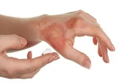 زنگ خطر سوختگی در کشور | آمار ایران ۸ برابر میانگین جهانی