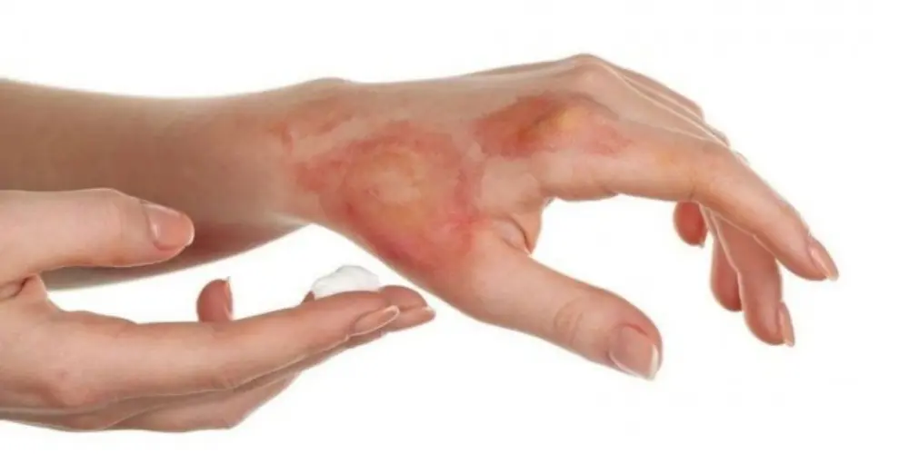 زنگ خطر سوختگی در کشور | آمار ایران ۸ برابر میانگین جهانی