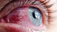 التهاب چشم یکی از نشانه‌های کرونا است 