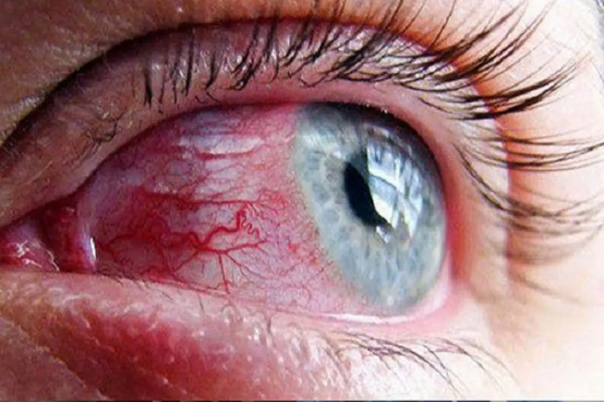التهاب چشم یکی از نشانه‌های کرونا است 