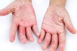 علائم و نشانه های پوستی کرونا چیست؟