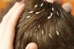 راه‌های درمان «شپش سر» 