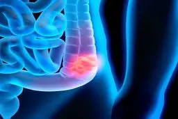 چه عواملی خطر ابتلا به سرطان روده را افزایش میدهد؟